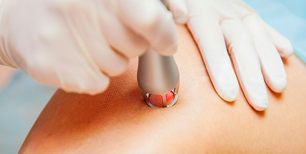 laser fraccionado mexico df moldeo corporal